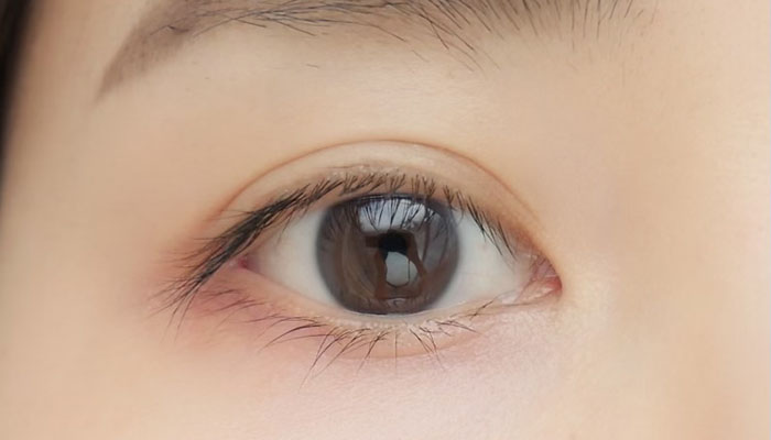 当院の眼瞼下垂の治療について