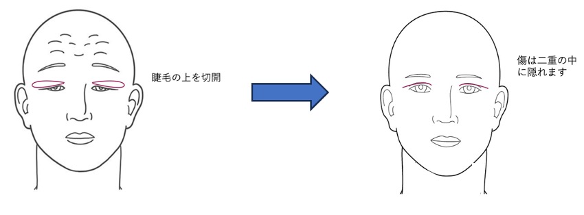 睫毛上皮膚切除