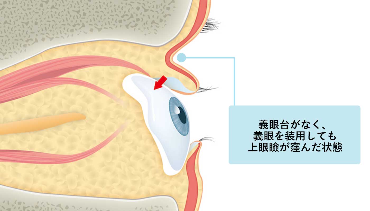 義眼台がなく上眼瞼が窪む状態